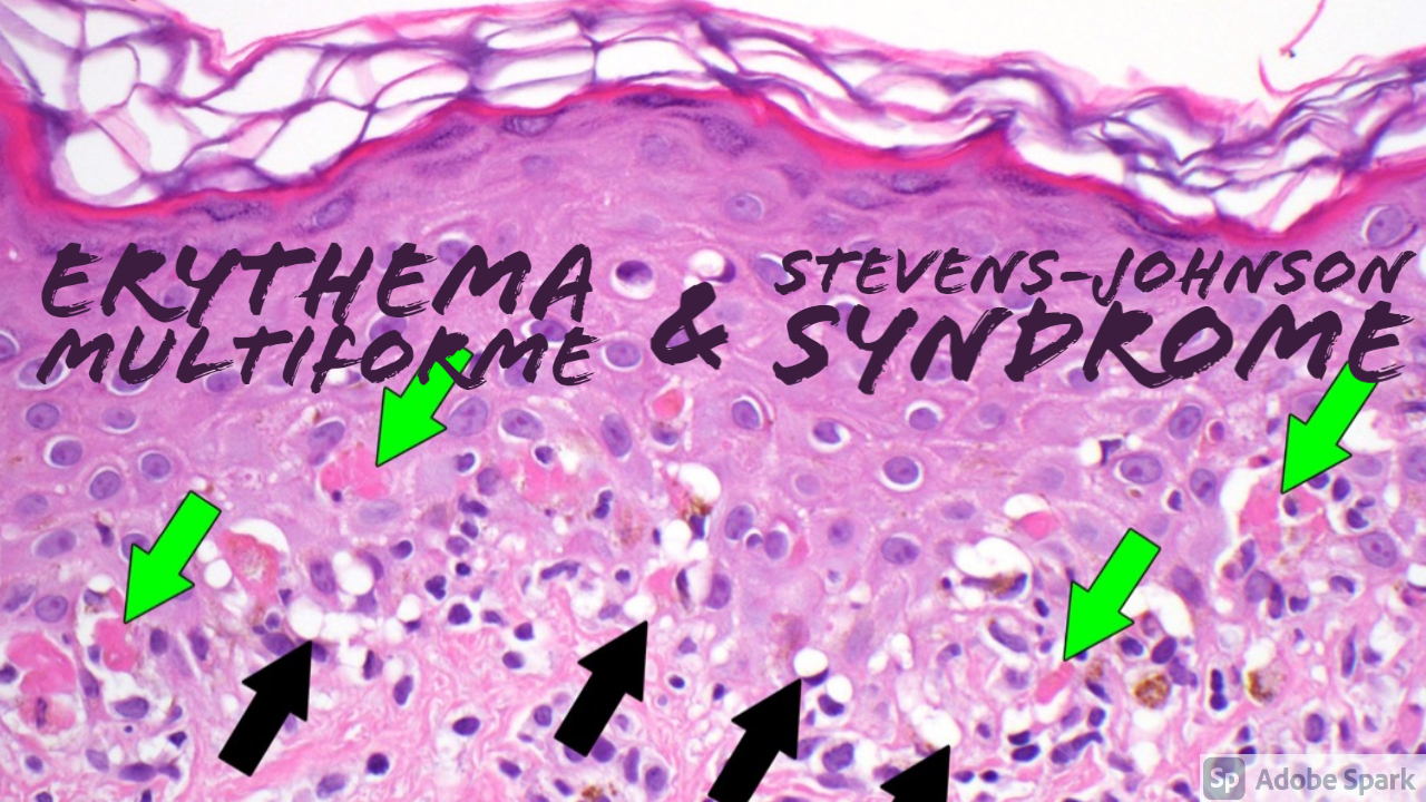 Erythema Multiforme And Stevens Johnson Syndrome Erythema Multiforme & Stevens-Johnson Syndrome/Toxic Epidermal